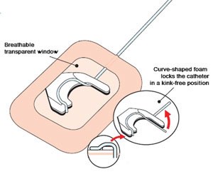 Epi-Fix securement device for epidural catheters